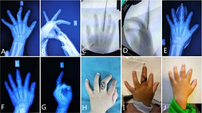 Phalangeal Intra-Articular Osteochondroma Caused a Rare Clinodactyly Deformity in Children: Case Series and Literature Review